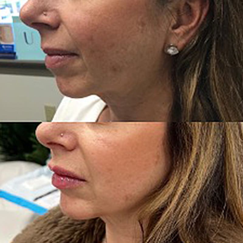 radiesse before and after