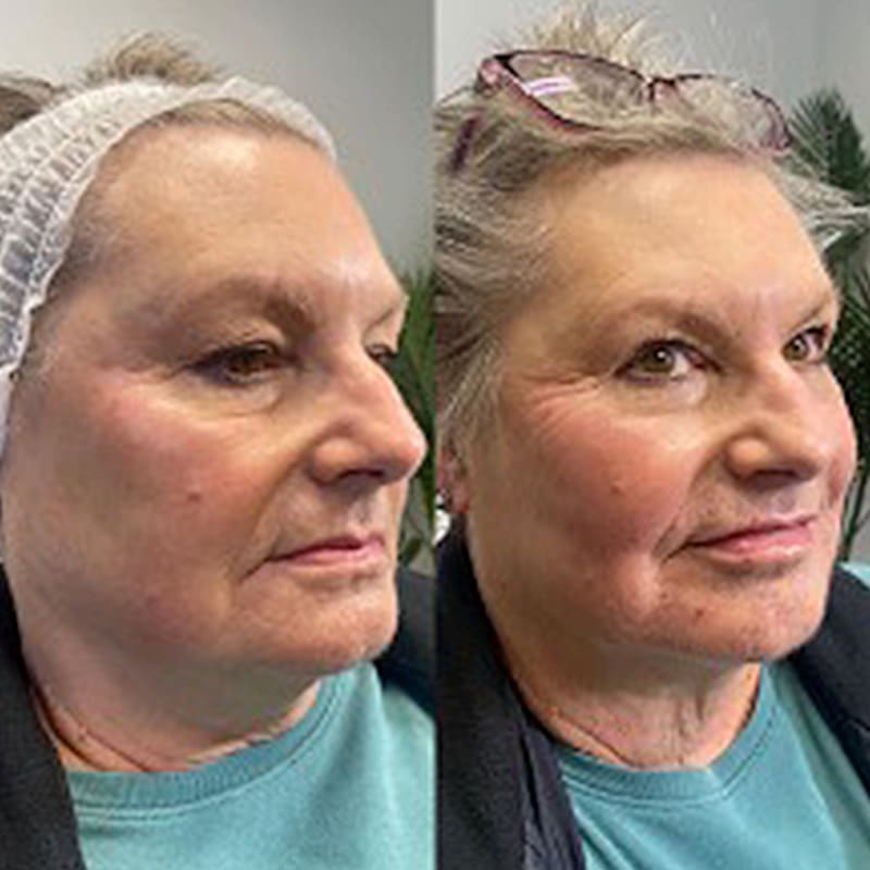 rha before and after