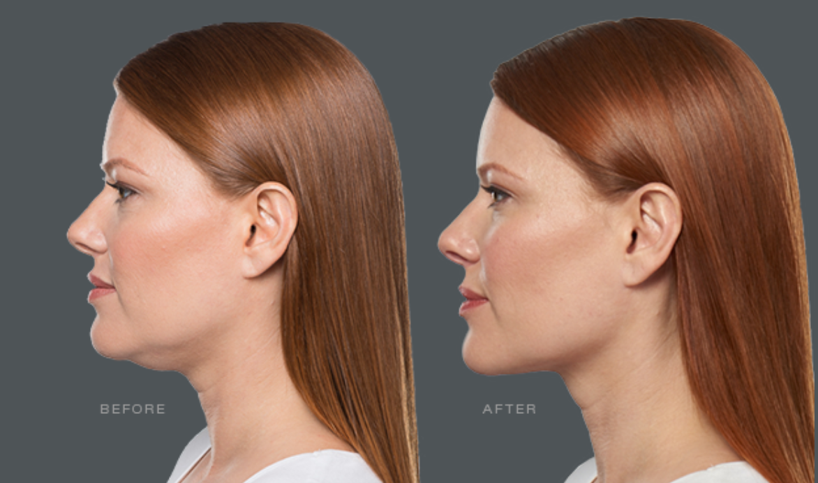 kybella treatment