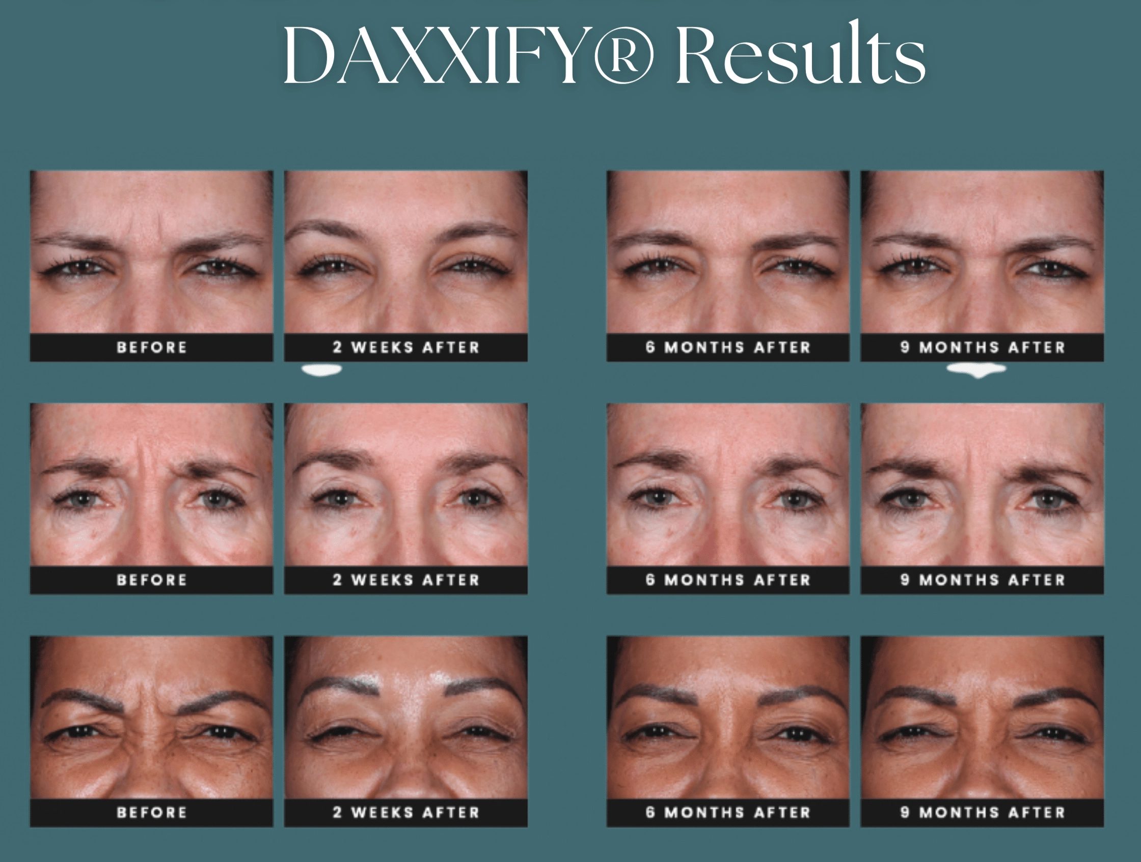 daxxify-injectable-before-and-after DAXXIFY Before and After