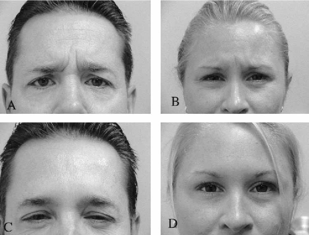 myobloc before and after